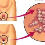 herpes genital herpes genital